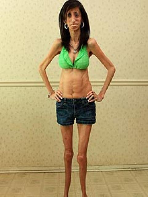 Lizzie Velasquez
